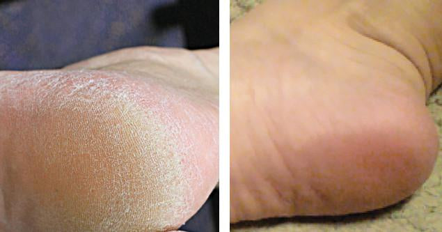 Softsole Express Exfoliating foot peel